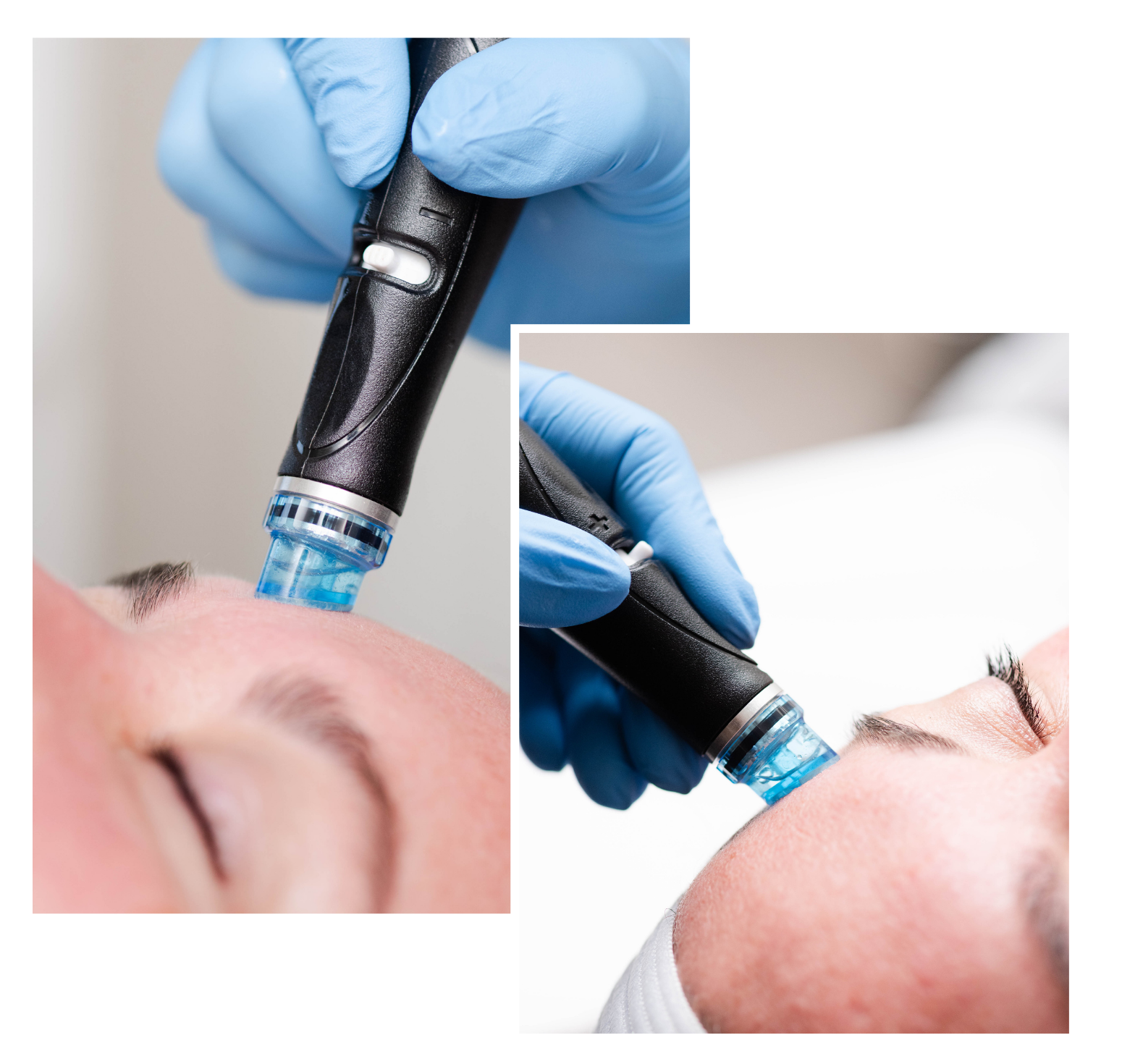 Hydrafacial in Syracuse, NY​